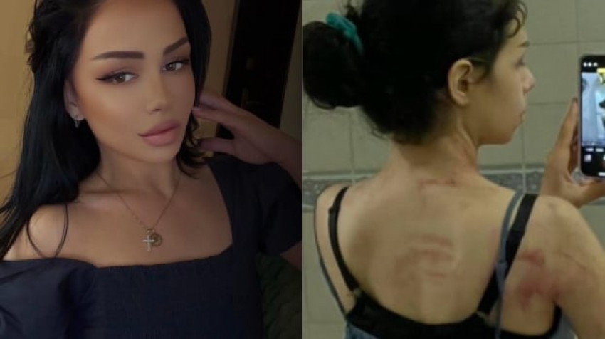 «Հարգեք ու սիրեք ինքներդ ձեզ». Մարի Պետրոսյանը կիսվել է մարմնի վրա բռնության հետքերով ու նշել, որ ամուսնալուծվել է